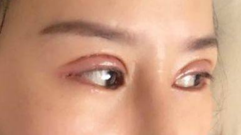 切双眼皮可以修复吗?切双眼皮多长时间内可以二次修复比较好?