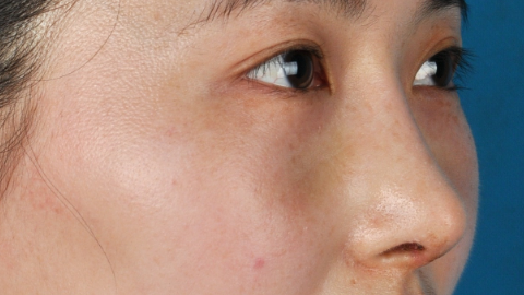 双眼皮消肿能变窄多少?双眼皮消肿会窄几毫米?