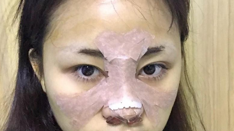 朝天鼻矫正多久消肿?朝天鼻矫正多久形成果?