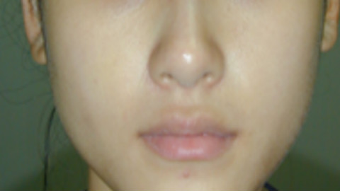 歪鼻矫正和隆鼻手术可以一起吗?歪鼻矫正和隆鼻的区别?