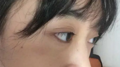 长春吉大一院热吉玛做的好吗?热吉玛手术案例及费用价格表