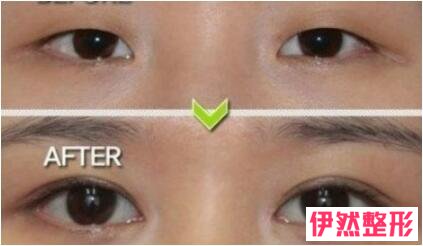 北京丽星翼美魏志香技术怎么样?附双眼皮修复案例,修复后的双眼皮真好看!