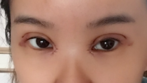 双眼皮修复会眼睁乏力吗?双眼皮修复没问题吗?
