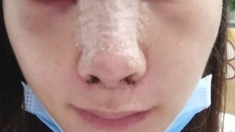 鼻部手术整形多久定型?鼻综整形合一般多久恢复?