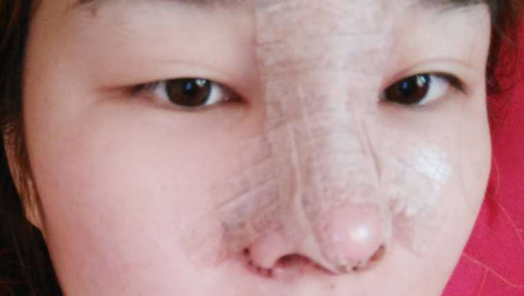 鼻部手术整形有后遗症吗?鼻部手术整形有哪些后遗症?