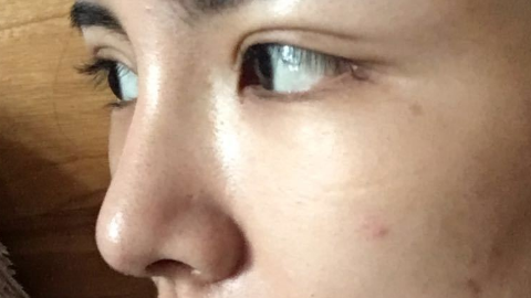 激光祛眼袋可以祛除开眼角的疤痕吗?激光祛眼袋能放大双眼吗?