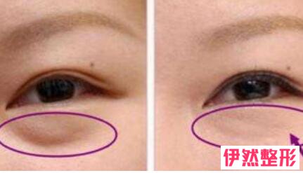 北京紫洁医疗去眼袋怎么样?北京紫洁不开刀去眼袋可靠吗?