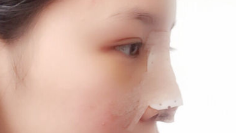 鼻部手术整形会改变眼睛形状吗?鼻部手术整形会增生吗?