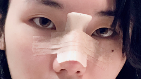 鼻部手术整形全麻还是局麻?鼻部手术整形打麻药疼吗?