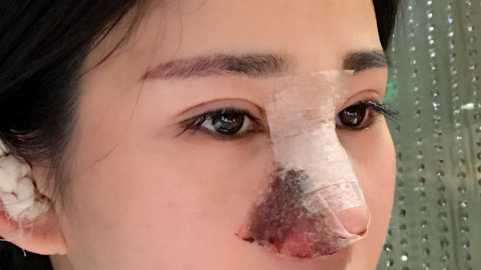 鼻部手术整形疼不疼?鼻部手术整形会流鼻血吗?
