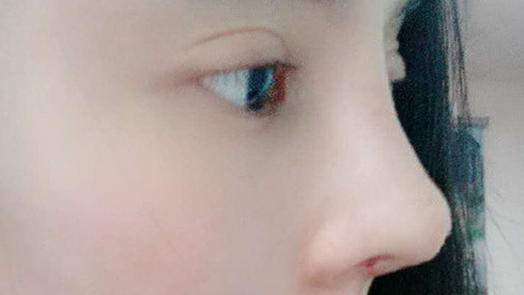 鼻部手术整形疼不疼?鼻部手术整形会流鼻血吗?