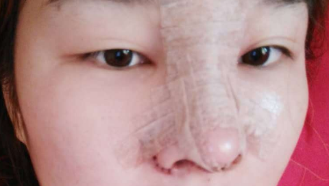 鼻部手术整形是什么意思?鼻部手术整形是长期的吗