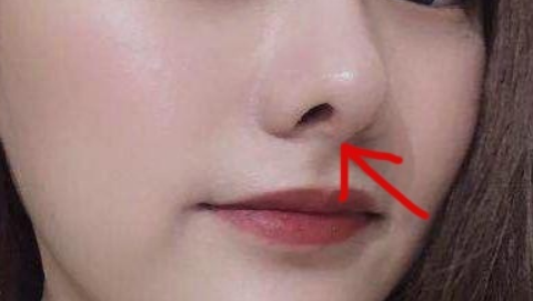 鼻部手术整形塑形怎么样?鼻部手术整形多久可以塑形?