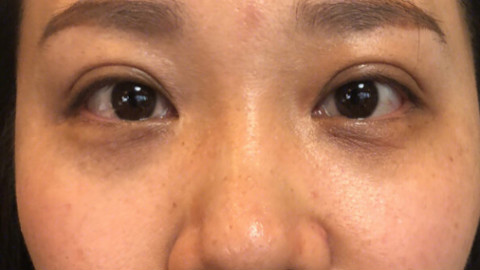 外切祛眼袋恢复期?外切去眼袋术后25天?