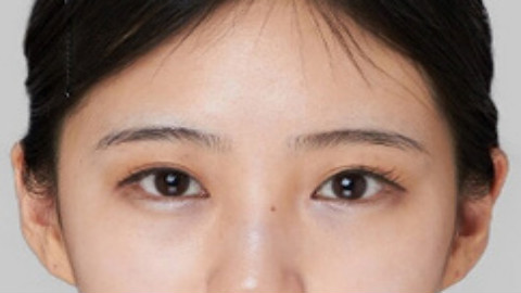 外切祛眼袋能祛除皱纹吗?会显年轻吗?