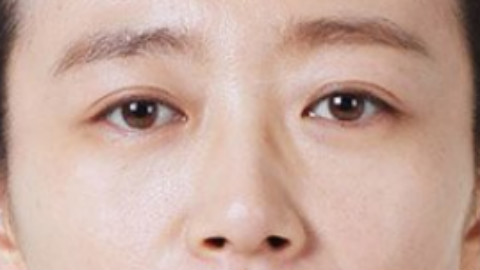 外切祛眼袋几天较肿期?外切祛眼袋可以热敷吗?