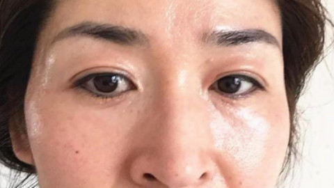外切祛眼袋能改良法令纹吗?外切祛眼袋会不会有泪沟?