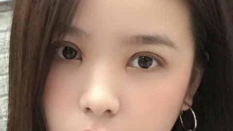 垫鼻基底是垫哪个位置?垫鼻基底是长期的吗?