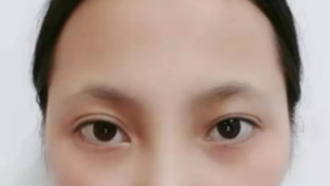 成都蓉雅晶肤做韩式三点双眼皮怎么样?双眼皮案例及价格表