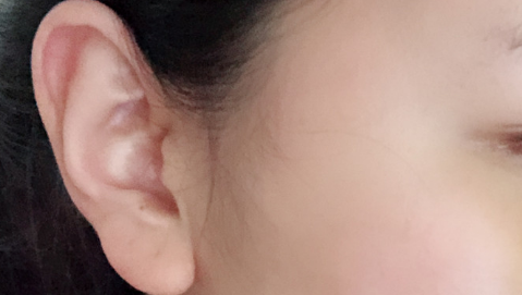 玻尿酸丰耳垂有果吗?玻尿酸丰耳垂果明X吗?