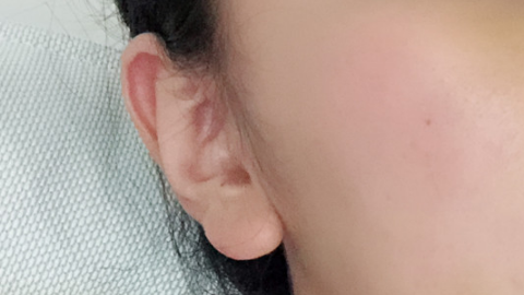玻尿酸丰耳垂前后?玻尿酸丰耳垂看着自然吗?