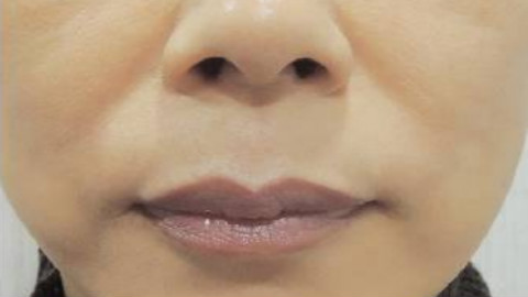 玻尿酸丰唇多久定型?玻尿酸丰唇多久可以变软?